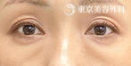 目の下のたるみ取り（ハムラ法、皮膚切除）の症例