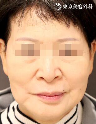 頬エランセ・ほうれい線ヒアルロン酸の症例写真 【2枚目】