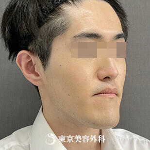 OGS（顎矯正手術、両顎手術）　の症例写真 【5枚目】