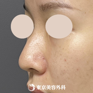 【隆鼻術、鼻尖形成、鼻中隔延長 ｜ok815792】の症例写真 before【1枚目】