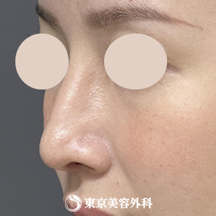 【隆鼻術、鼻尖形成、鼻中隔延長 ｜ok815792】の症例写真 after【2枚目】