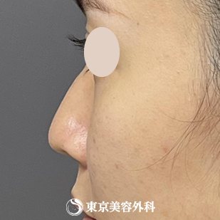 【隆鼻術、鼻尖形成、鼻中隔延長 ｜ok815792】の症例写真 before【3枚目】