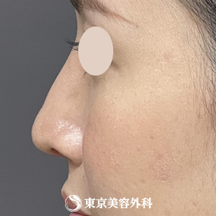 【隆鼻術、鼻尖形成、鼻中隔延長 ｜ok815792】の症例写真 after【4枚目】