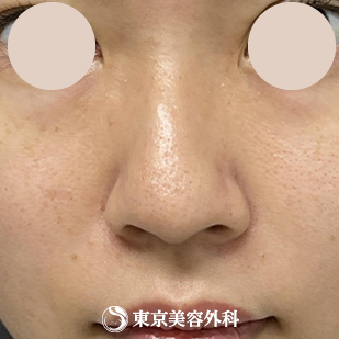【隆鼻術、鼻尖形成、鼻中隔延長 ｜ok815792】の症例写真 before【5枚目】