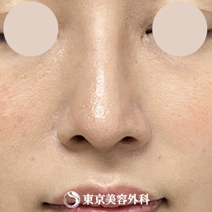 【隆鼻術、鼻尖形成、鼻中隔延長 ｜ok815792】の症例写真 after【6枚目】