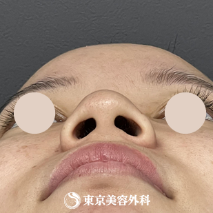 【隆鼻術、鼻尖形成、鼻中隔延長 ｜ok815792】の症例写真 before【7枚目】