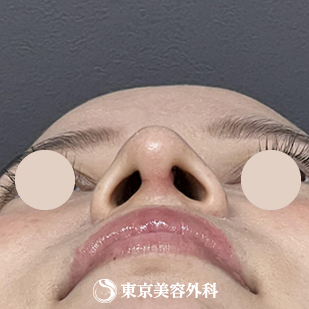 【隆鼻術、鼻尖形成、鼻中隔延長 ｜ok815792】の症例写真 after【8枚目】