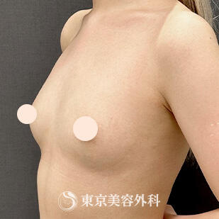 シリコンバッグ豊胸の症例写真 before【1枚目】