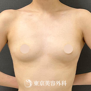 シリコンバッグ豊胸の症例写真 before【3枚目】