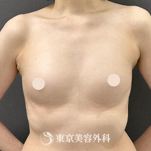 ヒアルロン酸除去＋シリコンバッグ豊胸の症例写真 before【3枚目】
