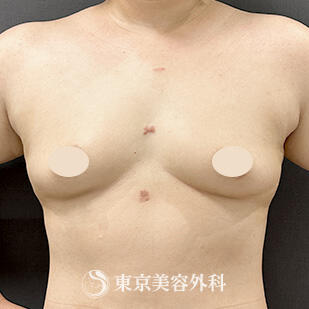 シリコンバッグ豊胸の症例写真 before【3枚目】
