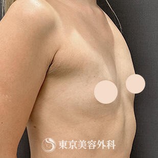 シリコンバッグ豊胸の症例写真 before【5枚目】