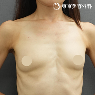 ヒアルロン酸溶解 除去＋シリコンバッグ豊胸（他院修正）の症例写真 before【3枚目】