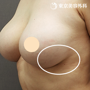 アクアフィリング除去、シリコンバッグ豊胸(他院修正)の症例写真 after【8枚目】