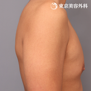 二の腕、肩VASER脂肪吸引の症例写真 術前【5枚目】
