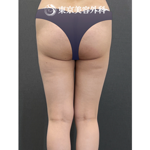ベイザー脂肪吸引（大腿全周～膝）の症例写真 術後6ヶ月【2枚目】