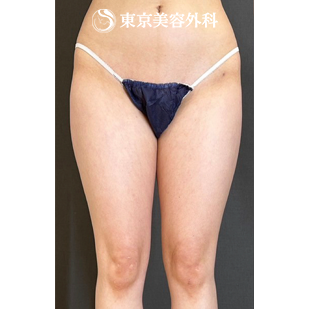 ベイザー脂肪吸引（大腿全周～膝）の症例写真 術前【3枚目】