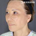 フェイスリフト＋ペリカン手術の症例