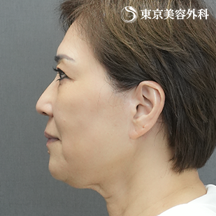 フェイスリフト＋ペリカン手術の症例写真 before【3枚目】