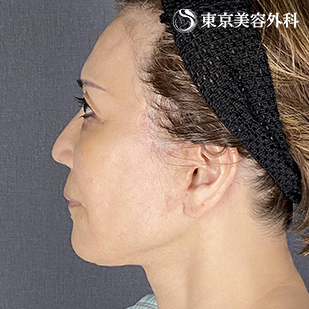 フェイスリフト＋ペリカン手術の症例写真 after【4枚目】