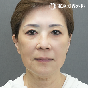 フェイスリフト＋ペリカン手術の症例写真 before【5枚目】