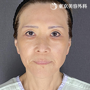 フェイスリフト＋ペリカン手術の症例写真 after【6枚目】