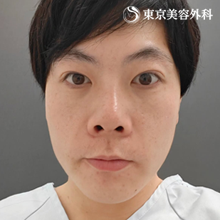 フェイスリフト／MACSリフト（ミニリフト）の症例写真 before【1枚目】