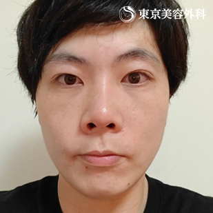 フェイスリフト／MACSリフト（ミニリフト）の症例写真 after【2枚目】