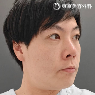 フェイスリフト／MACSリフト（ミニリフト）の症例写真 before【3枚目】