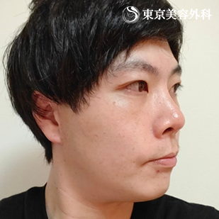 フェイスリフト／MACSリフト（ミニリフト）の症例写真 after【4枚目】