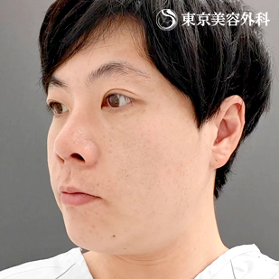 フェイスリフト／MACSリフト（ミニリフト）の症例写真 before【5枚目】