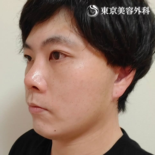 フェイスリフト／MACSリフト（ミニリフト）の症例写真 after【6枚目】