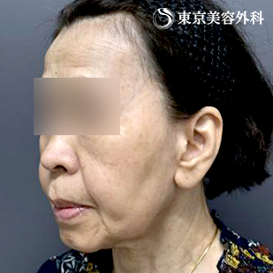 フェイスリフト+頬の脂肪吸引の症例写真 before【1枚目】