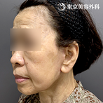 フェイスリフト+頬の脂肪吸引の症例