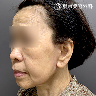 フェイスリフト+頬の脂肪吸引の症例写真 after【2枚目】