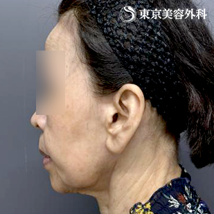 フェイスリフト+頬の脂肪吸引の症例写真 before【3枚目】