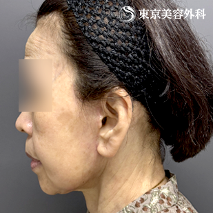 フェイスリフト+頬の脂肪吸引の症例写真 after【4枚目】