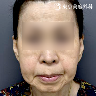 フェイスリフト+頬の脂肪吸引の症例写真 before【5枚目】