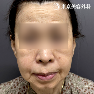 フェイスリフト+頬の脂肪吸引の症例写真 after【6枚目】