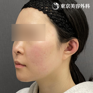 骨切り／下顎角形成＋オトガイ形成（Vライン形成）の症例写真 術後6ヵ月【2枚目】