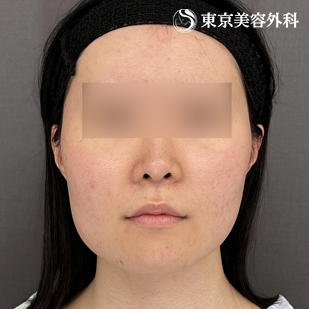 骨切り／下顎角形成＋オトガイ形成（Vライン形成）の症例写真 before【3枚目】