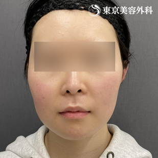骨切り／下顎角形成＋オトガイ形成（Vライン形成）の症例写真 術後6ヵ月【4枚目】
