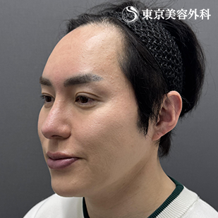 フェイスリフト（High SMASフェイスリフト）＋前額リフト（額縮小）の症例写真 before【3枚目】