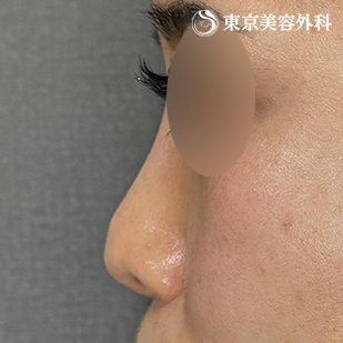 他院プロテーゼ抜去・鼻尖形成（切開法+軟骨移植）・隆鼻術（オーダーメードプロテーゼ）の症例写真 before【3枚目】