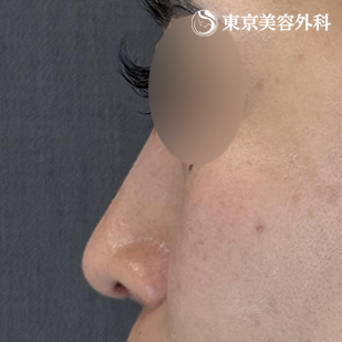 他院プロテーゼ抜去・鼻尖形成（切開法+軟骨移植）・隆鼻術（オーダーメードプロテーゼ）の症例写真 術後3ヵ月【4枚目】