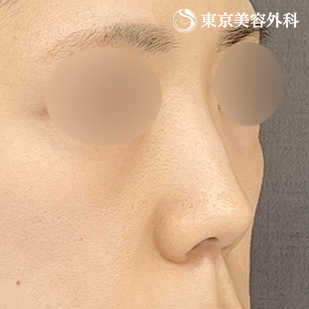 鼻尖形成（切開法+軟骨移植）・鼻中隔延長 （鼻軟骨移植法）・鼻骨骨切り・貴族手術（肋軟骨）の症例写真 before【1枚目】