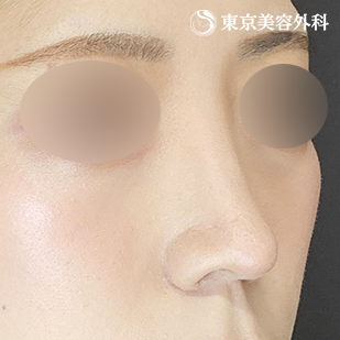 鼻尖形成（切開法+軟骨移植）・鼻中隔延長 （鼻軟骨移植法）・鼻骨骨切り・貴族手術（肋軟骨）の症例写真 術後6ヵ月【2枚目】
