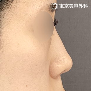 鼻尖形成（切開法+軟骨移植）・鼻中隔延長 （鼻軟骨移植法）・鼻骨骨切り・貴族手術（肋軟骨）の症例写真 before【3枚目】
