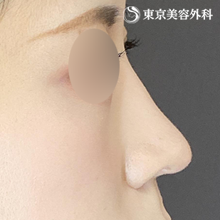 鼻尖形成（切開法+軟骨移植）・鼻中隔延長 （鼻軟骨移植法）・鼻骨骨切り・貴族手術（肋軟骨）の症例写真 術後6ヵ月【4枚目】