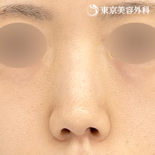 鼻尖形成（切開法+軟骨移植）・鼻中隔延長 （鼻軟骨移植法）・鼻骨骨切り・貴族手術（肋軟骨）の症例写真 before【5枚目】